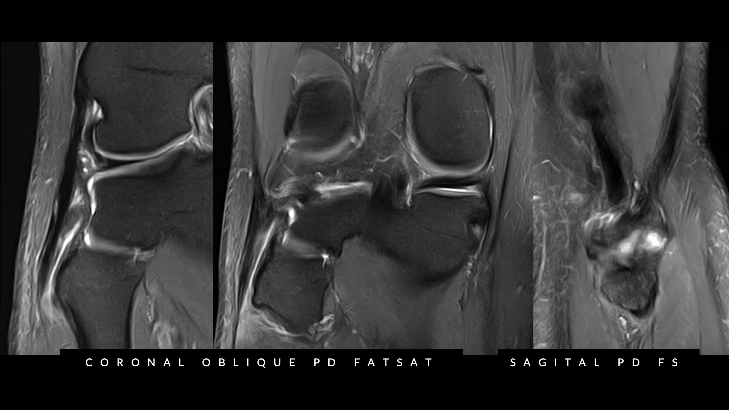 Figure 2 for case Isolated distal detachment of the lateral collateral ligament and biceps femoris tendon